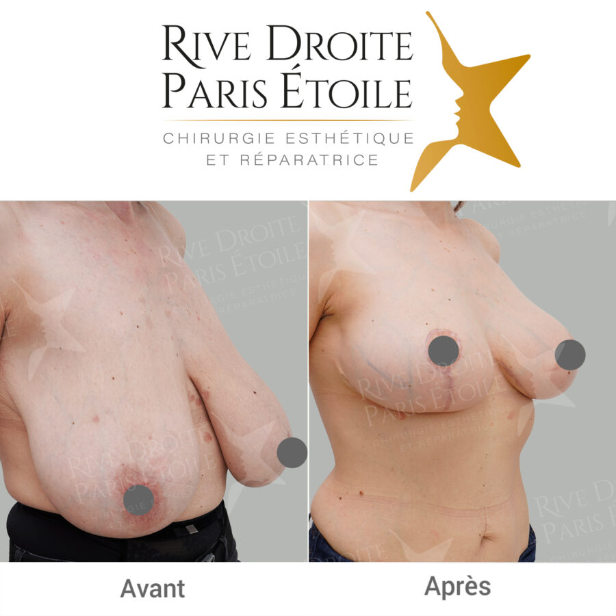 before and after breast reduction in Paris