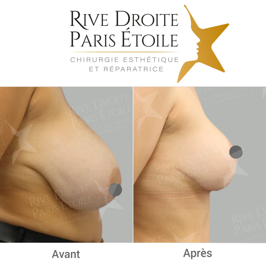 before and after breast reduction in Paris