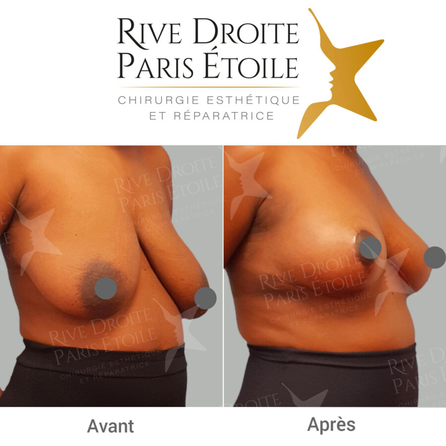 before and after breast reduction in Paris