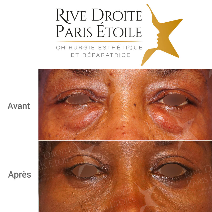 before and after blepharoplasty (eyelid surgery) in Paris