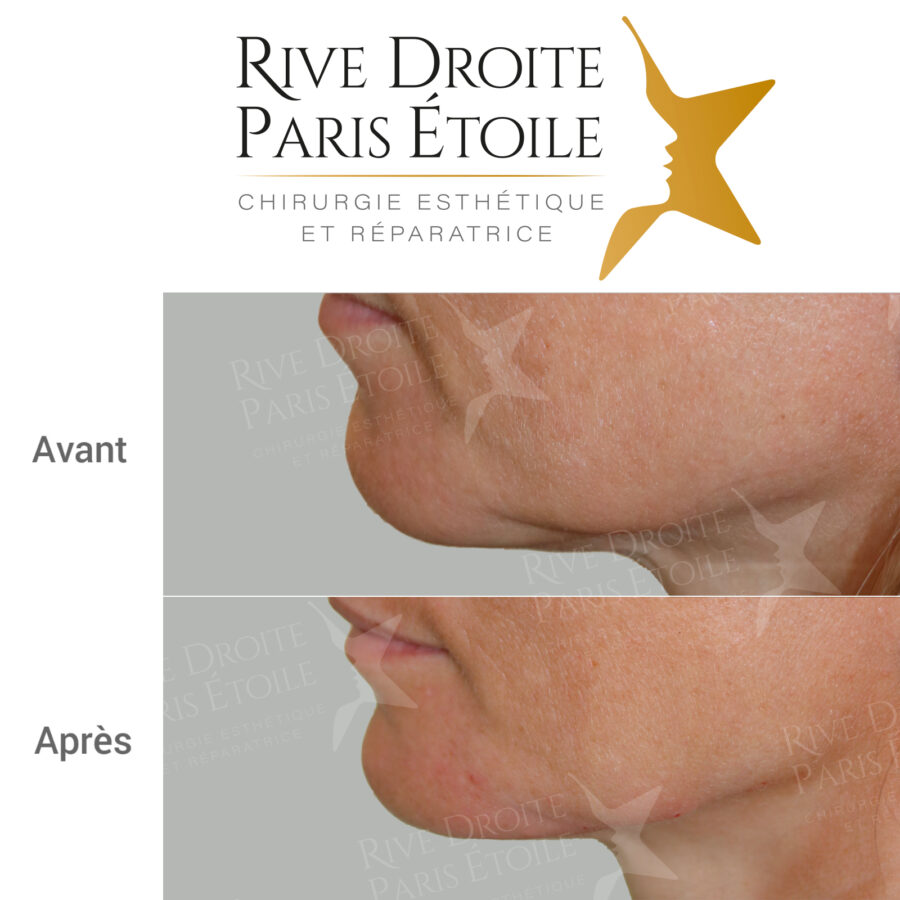before and after jawline contouring in Paris