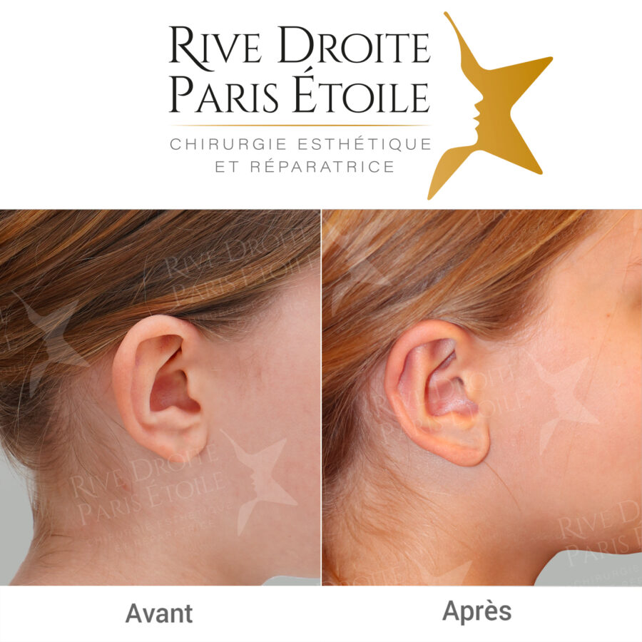 before and after otoplasty in Paris