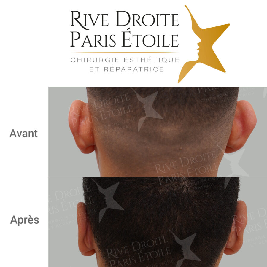 before and after otoplasty in Paris