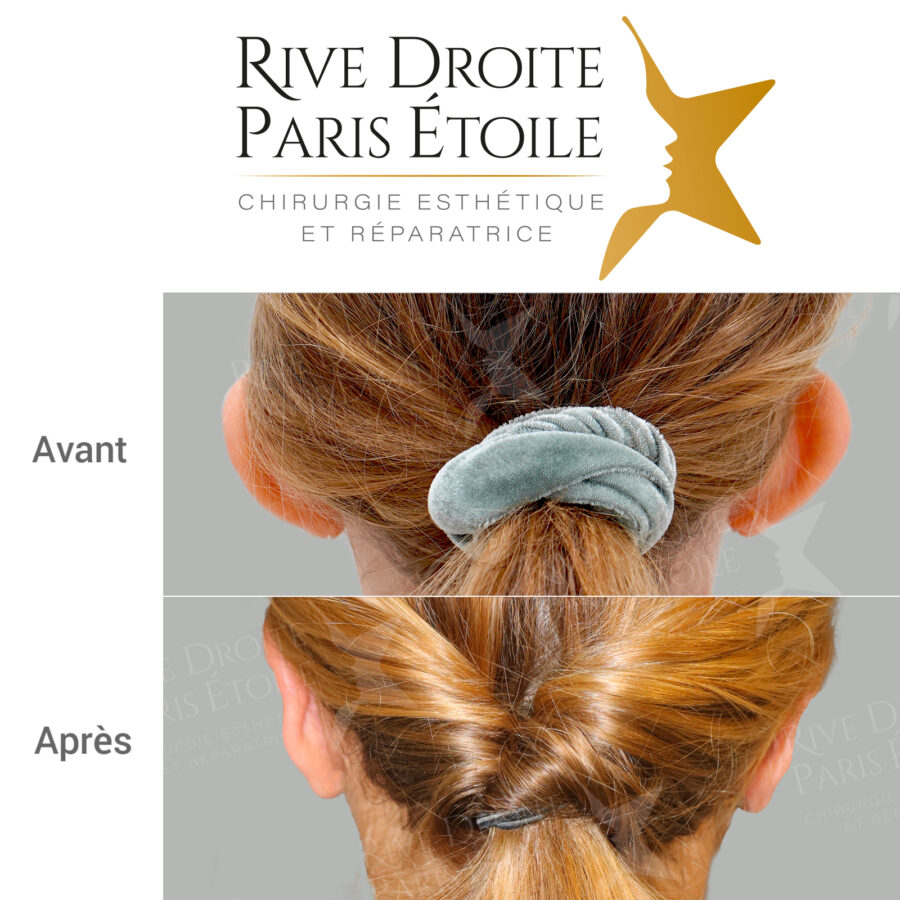 before and after otoplasty in Paris