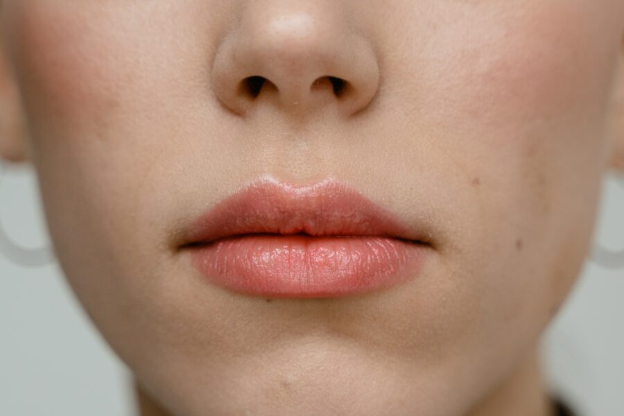 Rhinoplastie pointe remontée