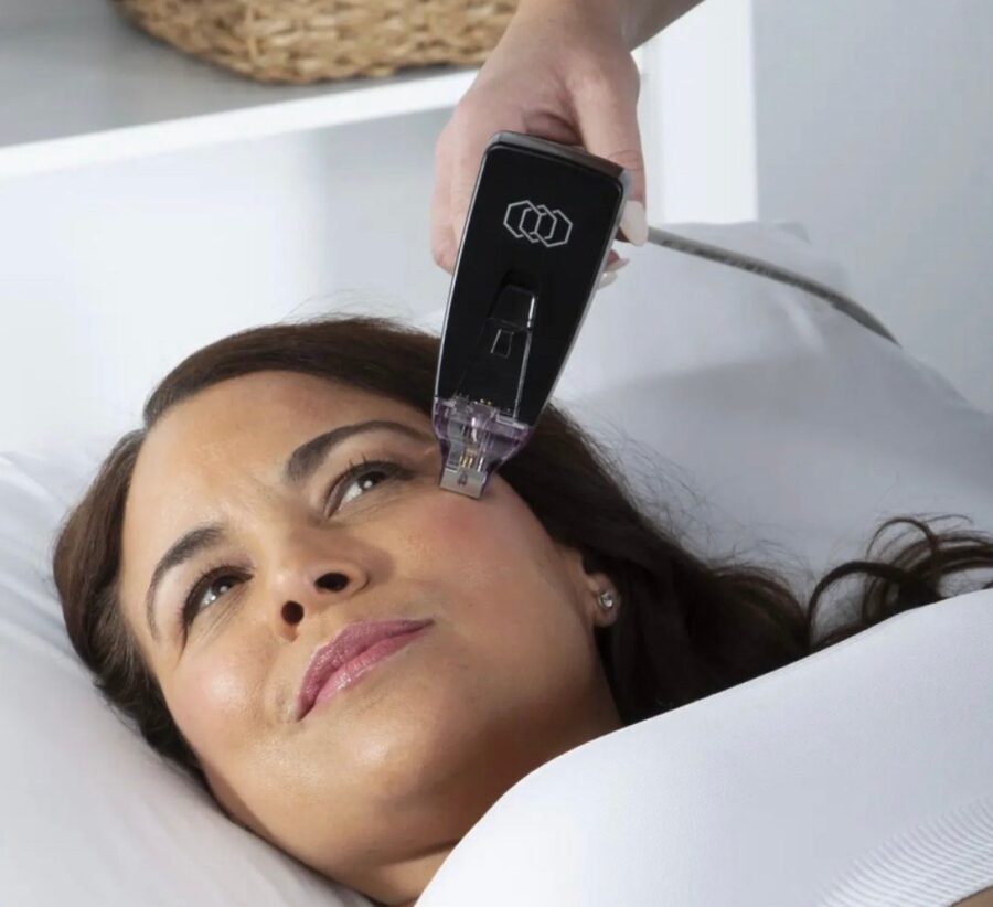 Morpheus8 : traitement de des imperfections du visage par radiofréquence fractionnée