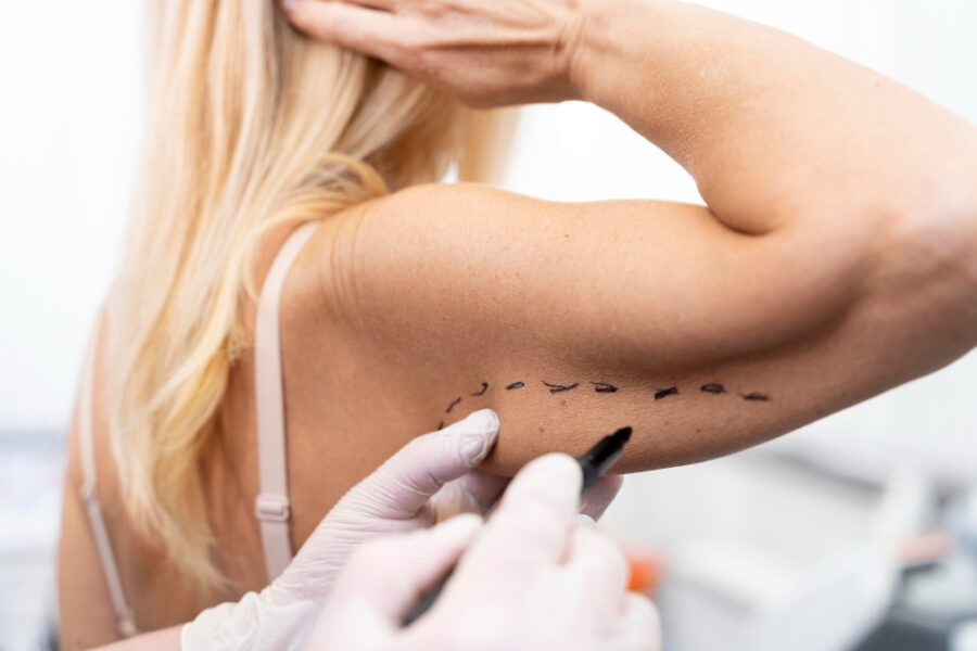 Aspiration de tissus graisseux sur le bras pour une liposculpture