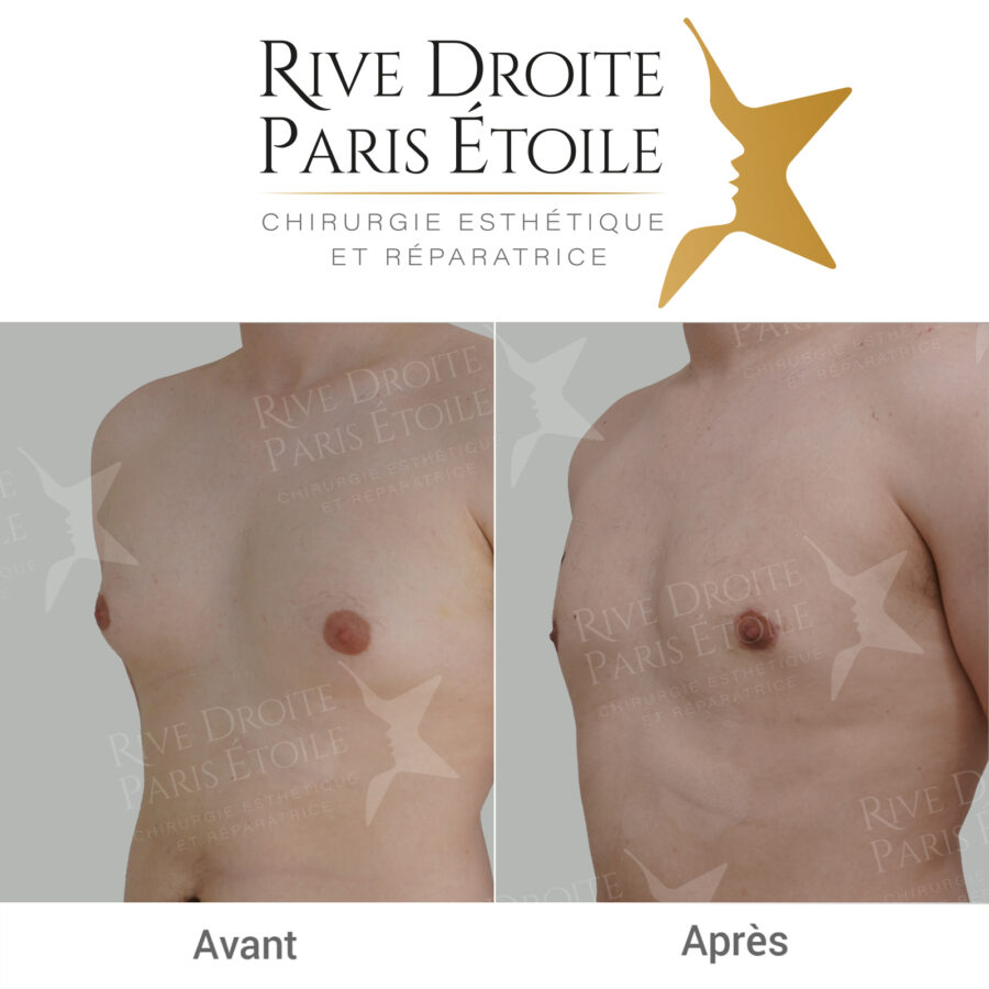 before and after gynecomastia in Paris