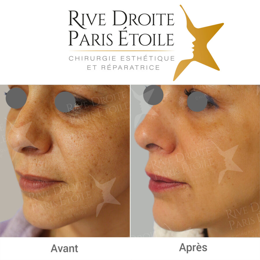 Before and after chemical peel for the face in Paris
