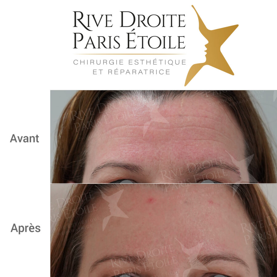 before and after Botox injection in Paris