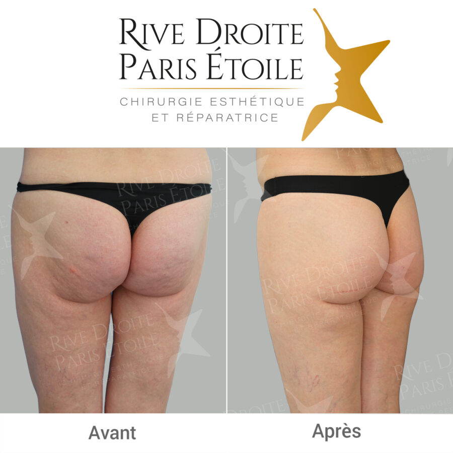 before and after HYAcorp buttock augmentation in Paris