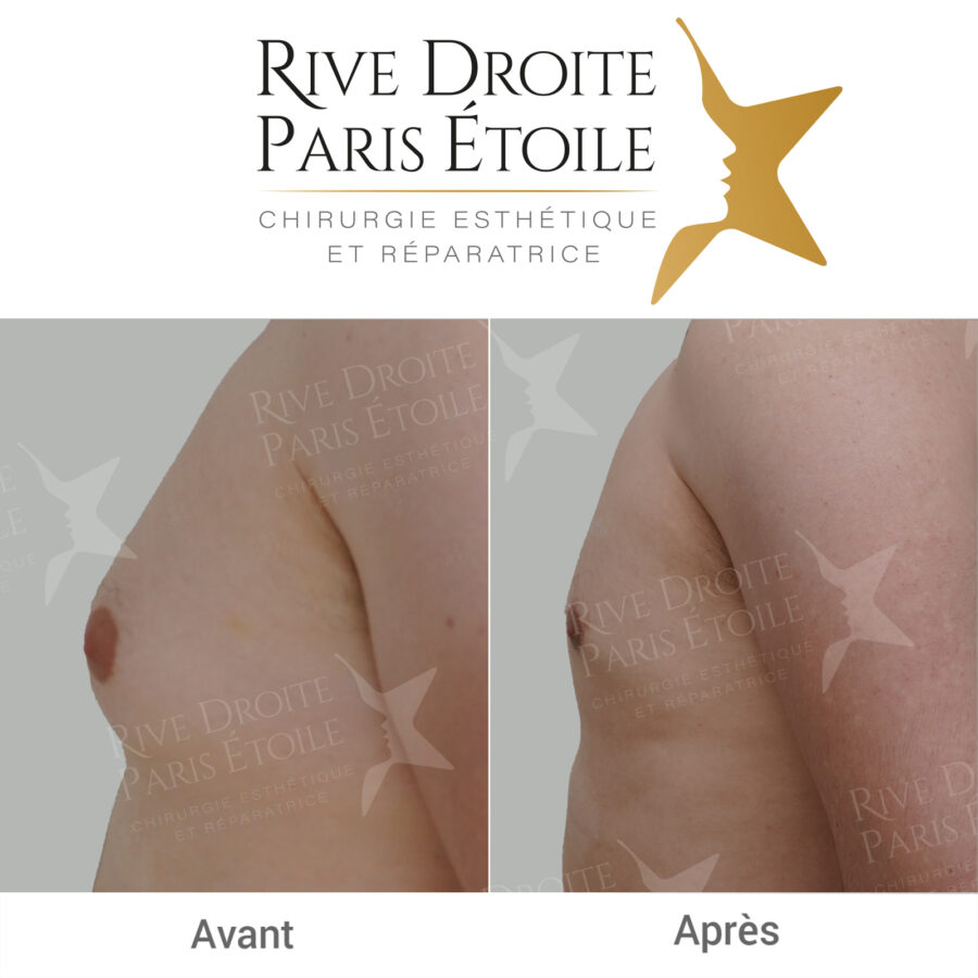 before and after gynecomastia in Paris