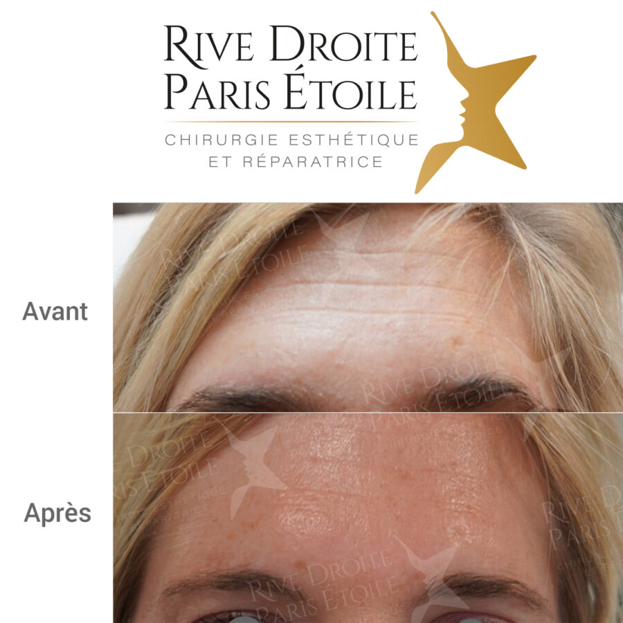 before and after Botox injection in Paris