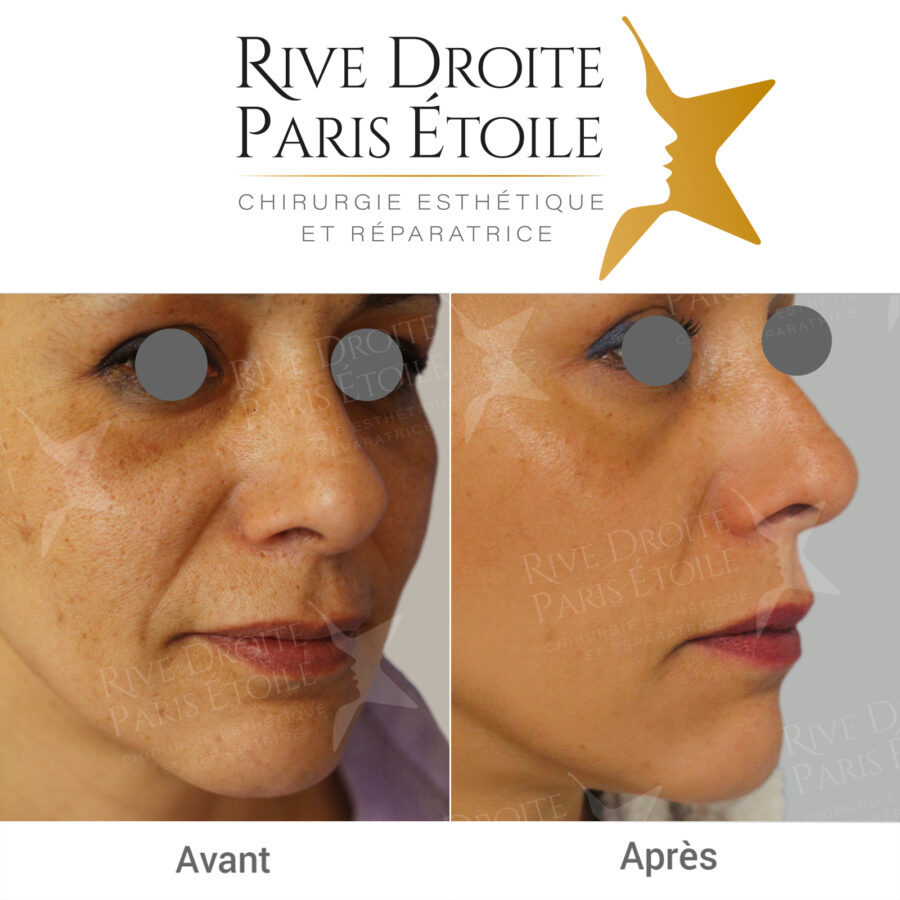Chemical peel for the face result — before and after in Paris