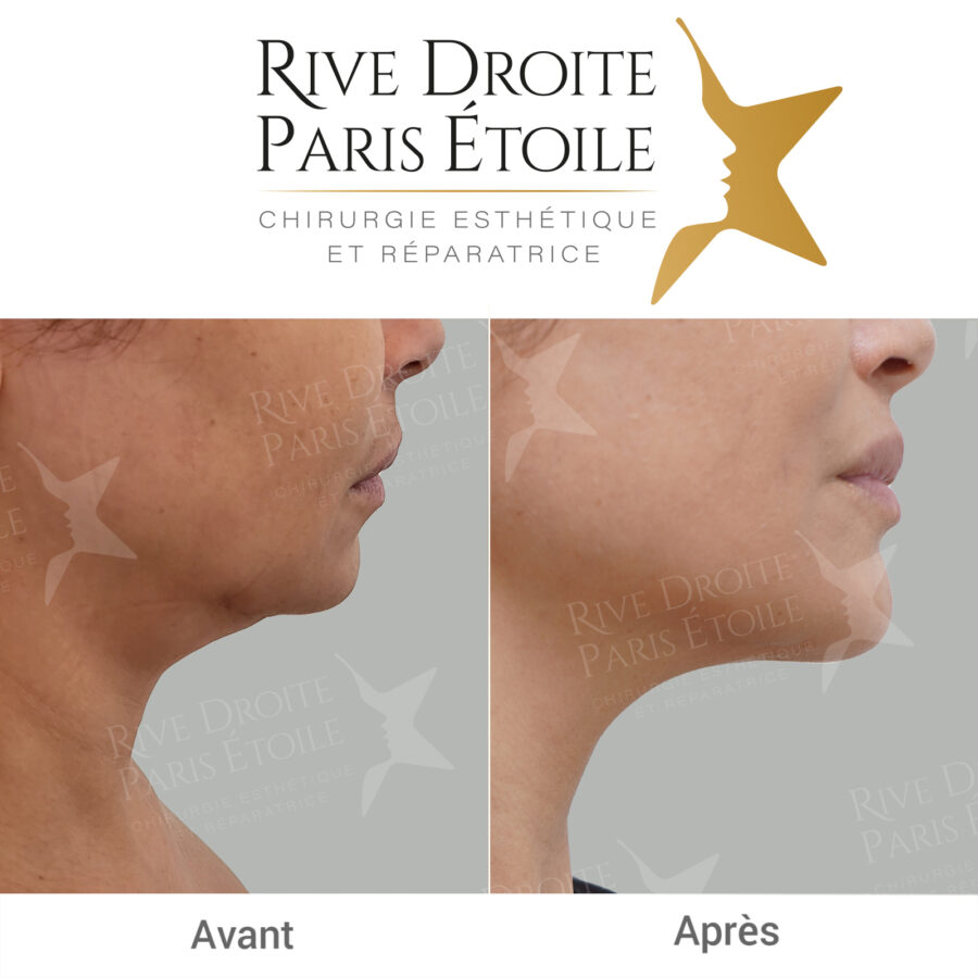 before and after Renuvion J-Plasma in Paris