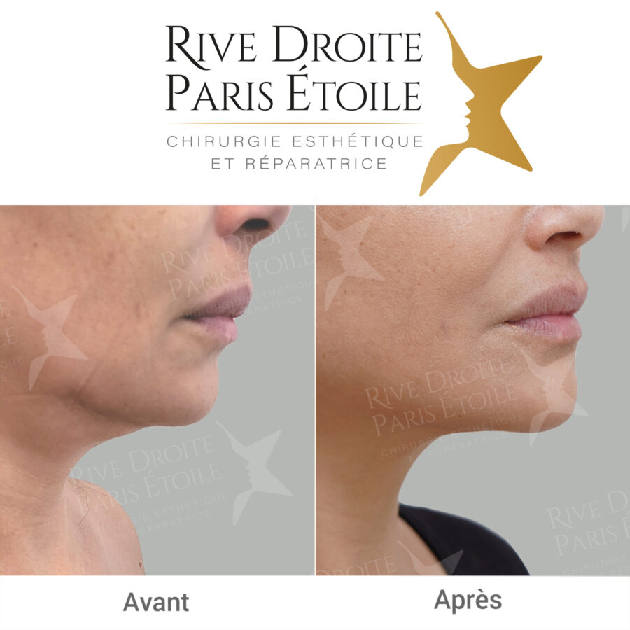before and after Renuvion J-Plasma in Paris