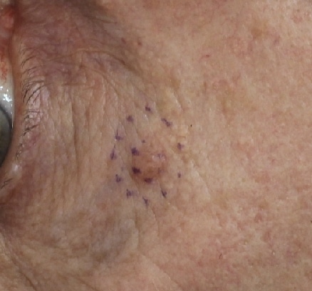 incision d'un carcinome cutané basocellulaire