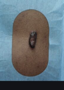 exemple de cicatrice hypertrophique opérée par le dr hunsinger