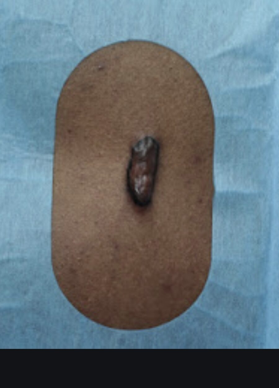 Hypertrophic scar before surgical revision in Paris