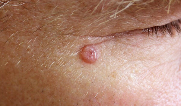 Aesthetic dermatology in Paris — screening and treatment of skin conditions