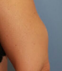 exemple de lipome sur membre inférieur