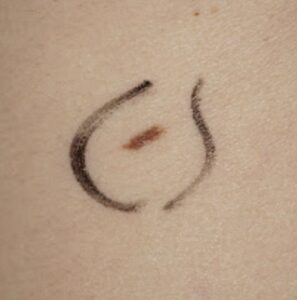 naevus irrégulier détecté par dermatoscopie numérique
