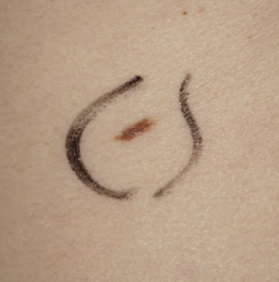 Irregular nevus analysed by digital dermoscopy in Paris