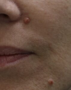 photographie d'un naevus tubéreux nécessitant une exérèse de grain de beauté