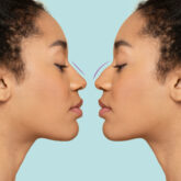 Rhinoseptoplastie redressement cloison nasale Paris
