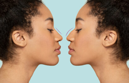 Rhinoseptoplastie redressement cloison nasale Paris