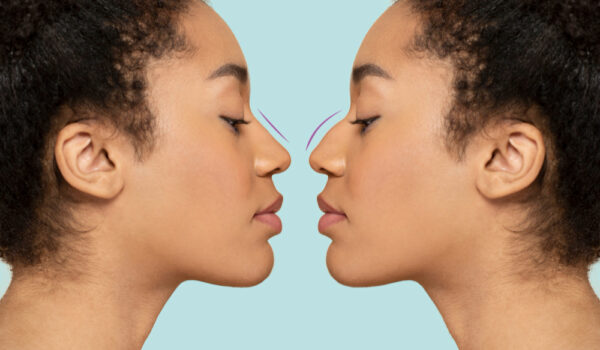 Rhinoseptoplastie redressement cloison nasale Paris