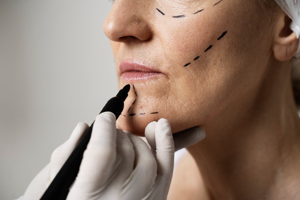 FFS facial feminization surgery