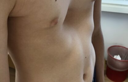 Surgical treatment of pectus excavatum — Rive Droite Paris Étoile clinic journal