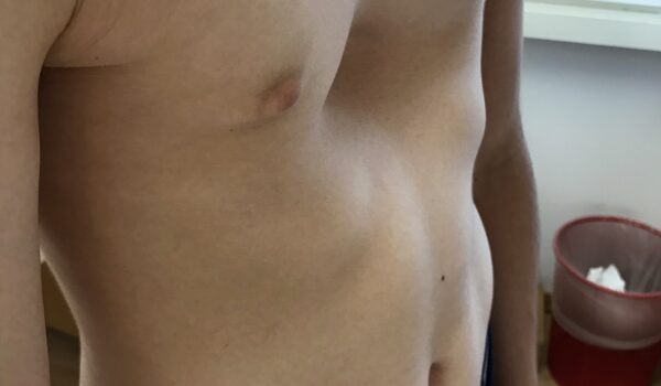 Traitement chirurgical pectus excavatum