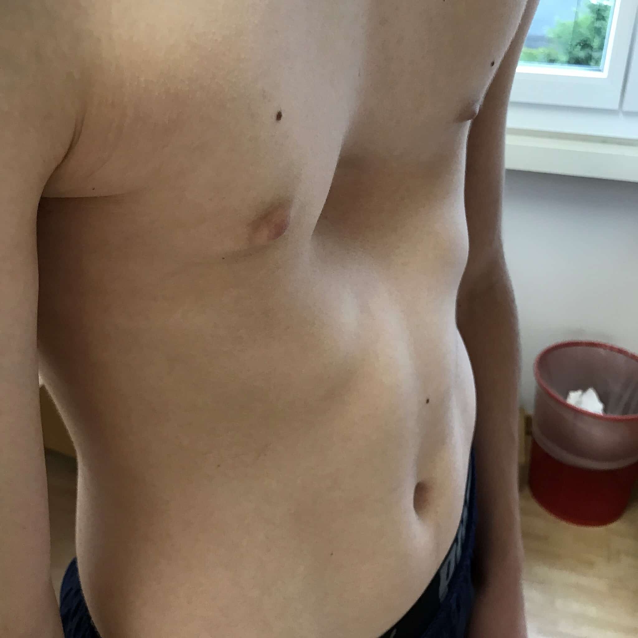 Surgical treatment of pectus excavatum