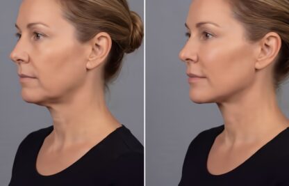 PDO, PLLA and PCL threads: what's the difference between absorbable thread lifts? — Rive Droite Paris Étoile clinic journal