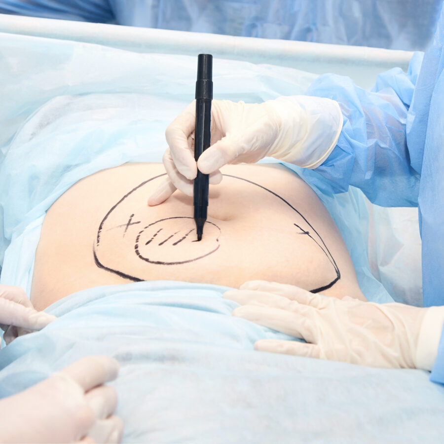 Abdominoplastie intervention chirurgicale