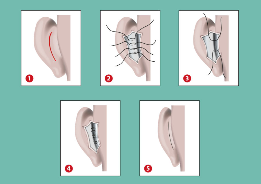 Chirurgie des oreilles décollées par otoplastie