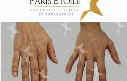 avant après Injection acide hyaluronique skinbooster dans les mains à Paris