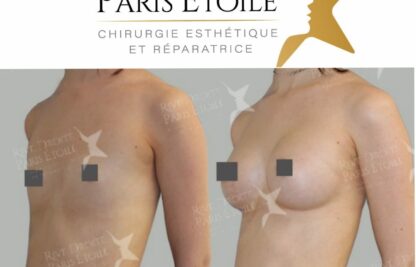avant après Prothèses mammaires à Paris