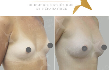 photo resultat augmentation mammaire sans implants